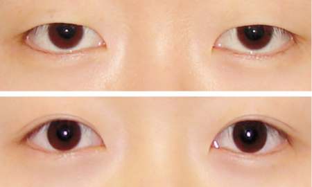 eye-1