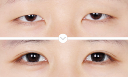 eye-3