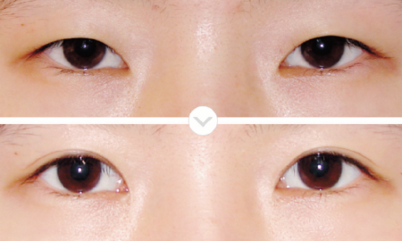 eye-5