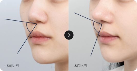 nose-3-2