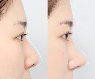 nose-3-3